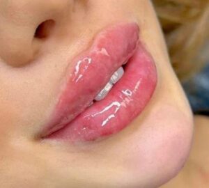 Ботокс губ